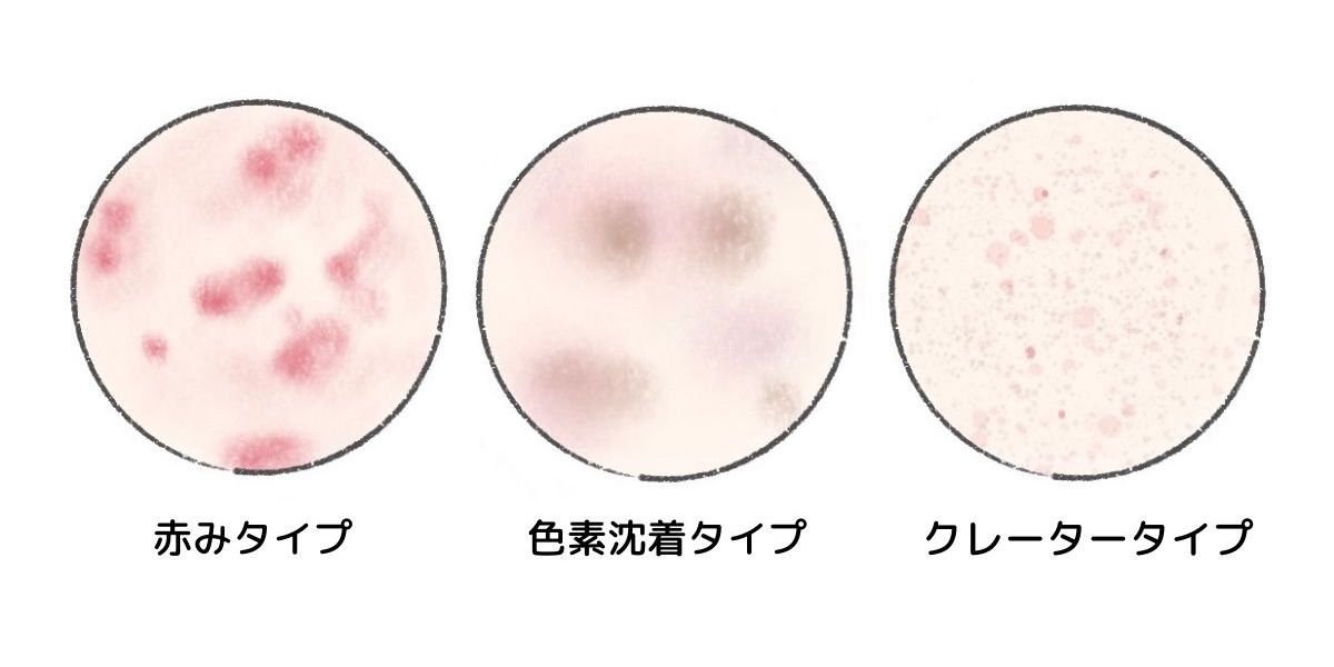 このニキビ跡 様子見 セルフケアじゃ消えないニキビ跡の美容医療入門 Mismos ミスモス