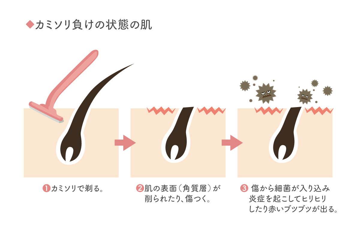 赤み 肌荒れ カミソリや毛抜きでのムダ毛ケアのトラブルを何とかして お肌レスキュー隊 Mismos ミスモス 赤み 肌荒れ カミソリや毛抜きでのムダ毛ケアのトラブルを何とかして お肌レスキュー隊 Mismos ミスモス