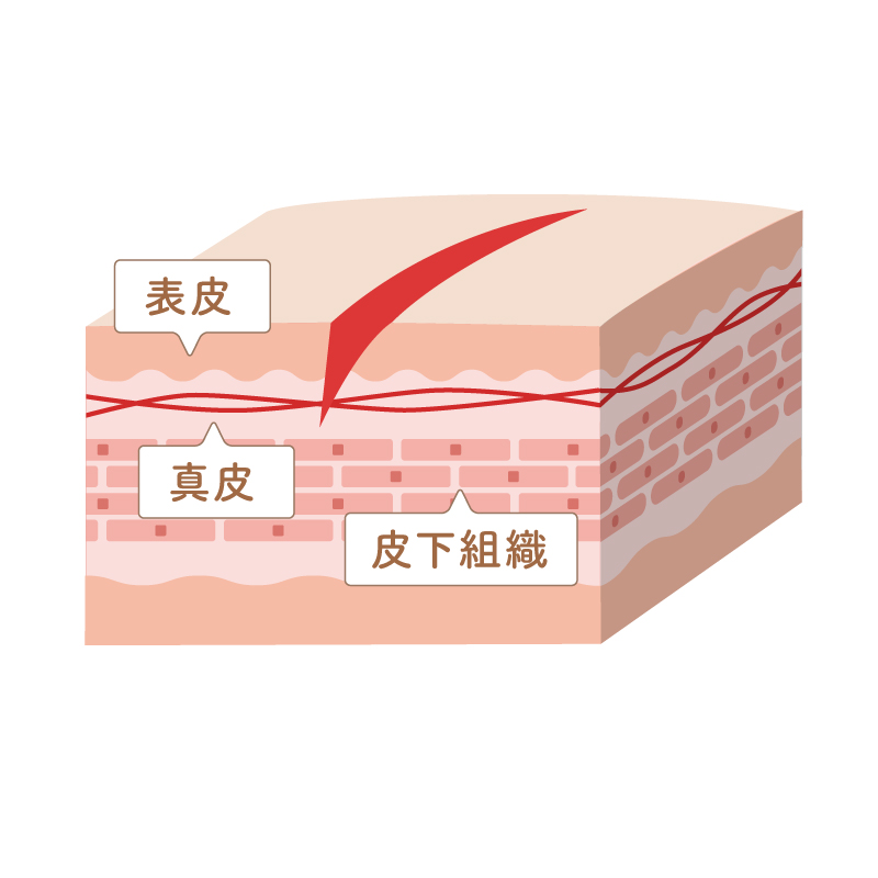 ケガした傷跡…残らないようにするためのケアを教えて!【お肌レスキュー隊】 | mismos(ミスモス)