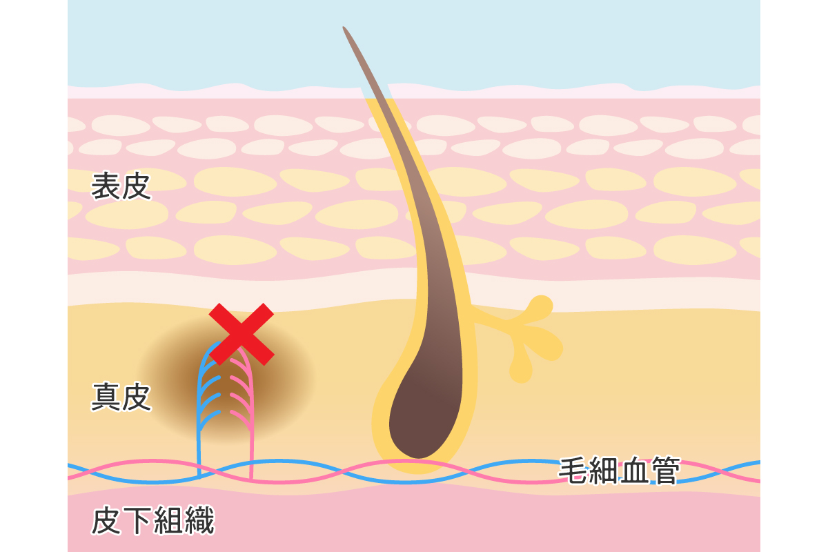 絶対バレたくない！キスマークの上手な隠し方＆消し方を教えて！【お肌レスキュー隊】 | mismos（ミスモス）